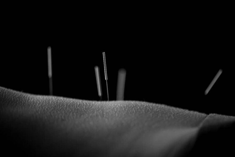acupuntura beneficios