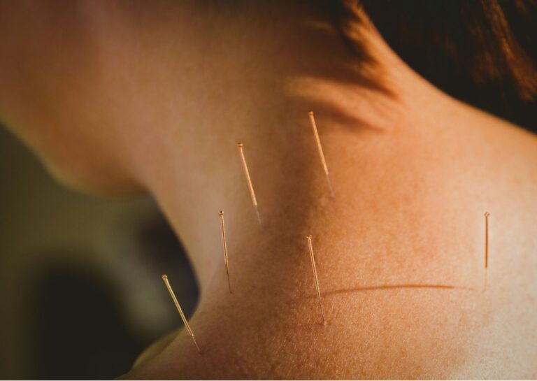 acupuntura 2