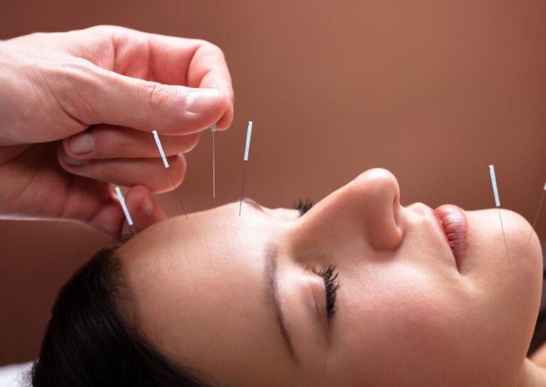 acupuntura 3