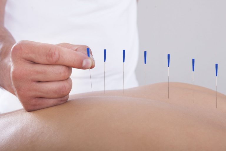 Acupuntura2