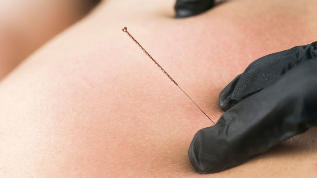 Agulhamento a seco (Dry Needling): O que é e para que serve 1 Agulhamento a seco