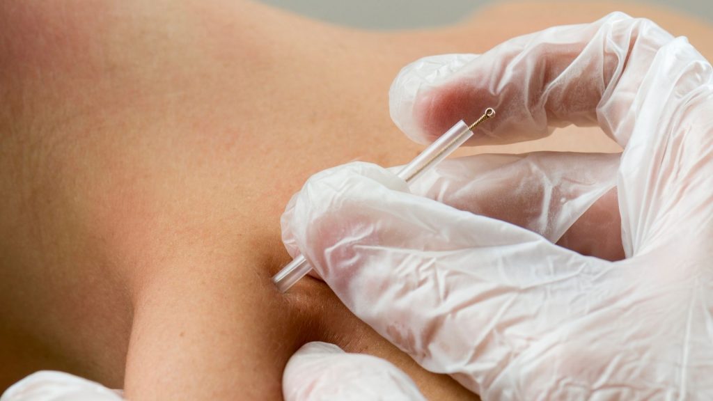 Agulhamento a seco (Dry Needling): O que é e para que serve 2 Agulhamento a seco