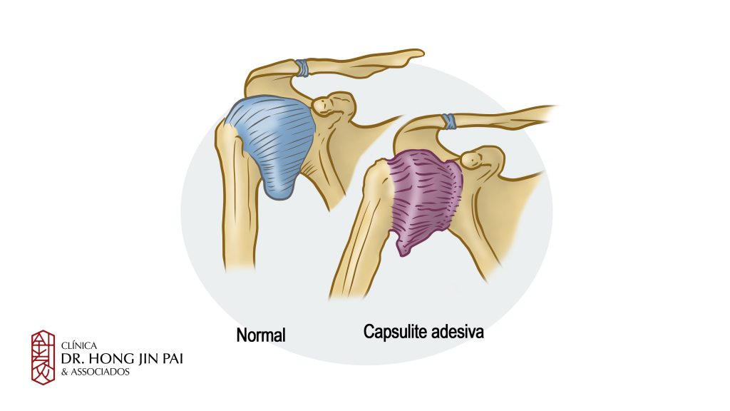 capsulite adesiva ombro