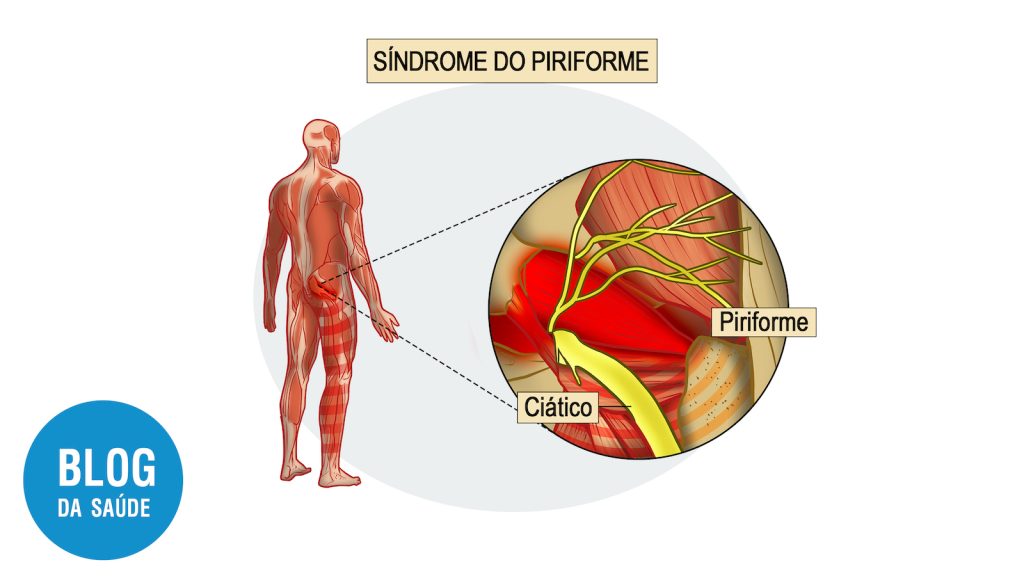 SÍNDROME DO PIRIFORME