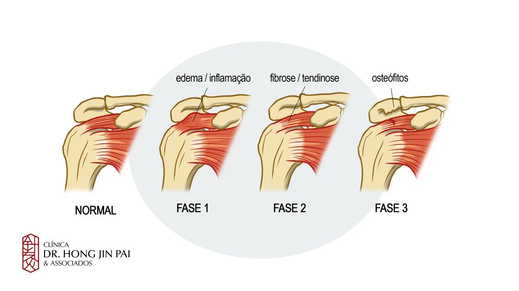 tendinite ombro fases