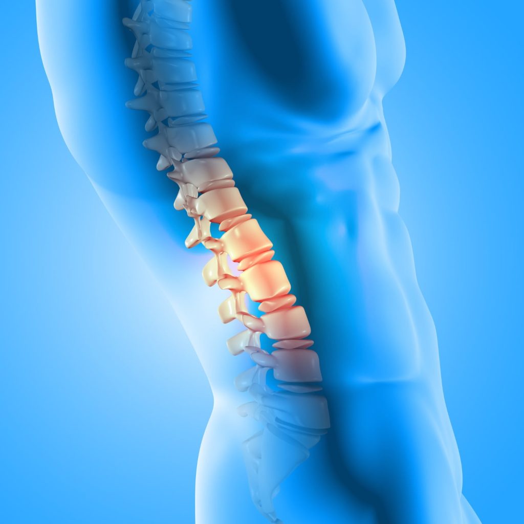 Fratura por osteoporose na coluna: dor súbita nas costas em idosos